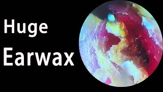 Full video of cleaning earwax a good chunk was pulled out！ear earwax relax [upl. by Altman]