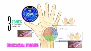 Three zones of ulnar nerve compression in Guyons canal Ulnar nerve entrapment neuropathy anatomy [upl. by Aled]