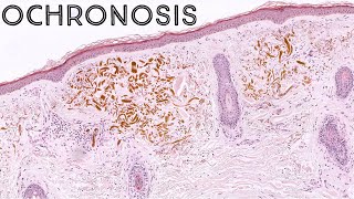 Exogenous Ochronosis possible side effect of hydroquinone skin lightening cream pathology dermpath [upl. by Schiffman]