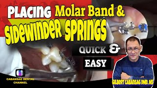 how to apply molar bands amp Sidewinder springs quick and easy [upl. by Ontine952]