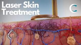 Next Generation Laser Treatment of Skin Lesions and Pigmentation by Candela 3D medical animation [upl. by Yentyrb]