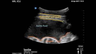 Ultrasound guided drainage of Ascites [upl. by Garihc]