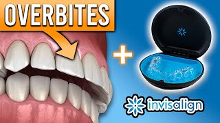 Can Invisalign FIX Overbites amp Other Bite Problems  Premier Orthodontics [upl. by Elvis546]