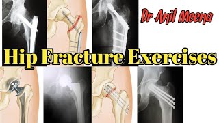 Hip Fracture Recovery Exercise  hip joint Fracture Exercise  Exercise after Hip Surgery  in hindi [upl. by Asiilanna326]