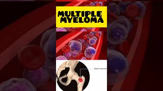 Multiple myeloma multiplemyeloma malayalam cancer hypercalcaemia high calcium genetics [upl. by Raybourne]