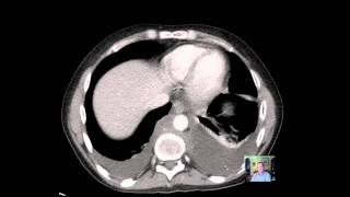 CT Chest ADENOPATHY Discussion [upl. by Ati]