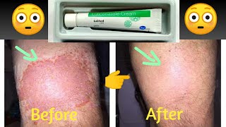 Luliford Cream For Fungal Infections  Luliconazole Ointment For Fungal Infections Completely Cure [upl. by Embry]