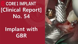 CYBERMED Clinical Report 45 Implant placement with Apically positioned flap [upl. by Bennink]