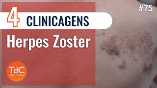 4 Clinicagens sobre Herpes Zoster  Episódio 75 [upl. by Elimac969]