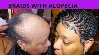 LACE FRONT BRAIDS WITH ALOPECIABRAIDS WITH ALOPECIA [upl. by Ydnarb]