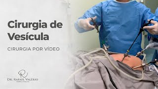 Cirurgia Real de Vesícula por Vídeo [upl. by Segalman658]