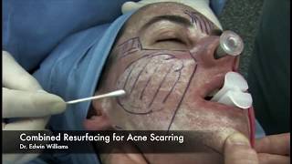 Laser amp Dermabrasion Treatment for Acne Scarring by Dr Edwin Williams [upl. by Yecniuq]