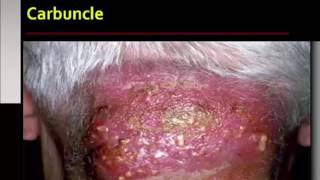 Bacterial Infections of the Skin [upl. by Balas]