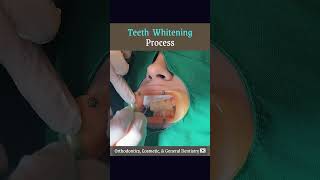 Teeth Whitening Process [upl. by Parke]