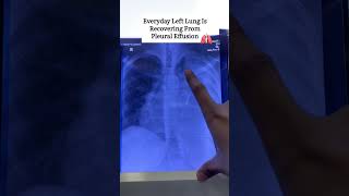 Patient Recovery physioshealingtouch xray recovery chest [upl. by Aaronson]