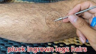 PLUCK INGROWN LEGS HAIRS for Mr saqefcnkhfxvnmgxvv [upl. by Albertina]