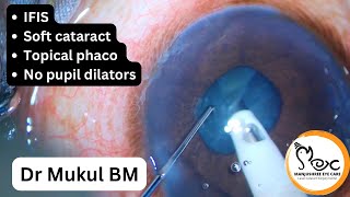 IFIS surprise  soft cataract  Topical phaco [upl. by Rambert599]