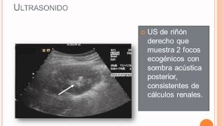 Litiasis Renal  Parte 3 [upl. by Anirtac]