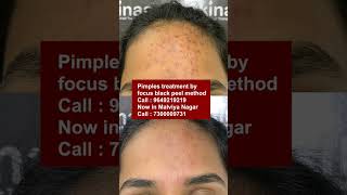 Best Pimples treatment by focus black peel method at skinaa clinic  Viral shorts [upl. by Ytitsahc143]