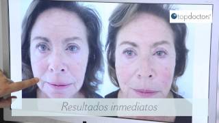 Hilos tensores para el tratamiento facial [upl. by Onaivlis]