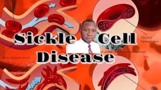 SICKLE CELL DISEASES [upl. by Keyes]