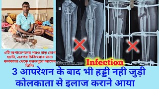 tibia fibula and femur fracture ilizarov surgery fail kolkata se bharatpur ilaaj ke liye aaya [upl. by Qooraf]