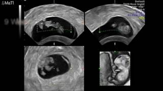 Baby Ultrasound early pregnancy 56789 weeks 3D [upl. by Eiromem]