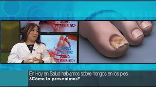 Entérate cómo prevenir los hongos en los pies HOY EN SALUD [upl. by Nnylyaj192]