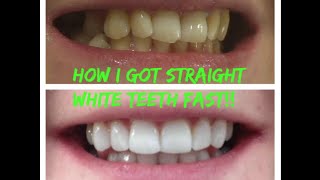 My Inman Aligner experience how i straightened my teeth [upl. by Jonah]