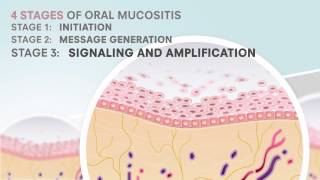 Oral Mucositis and Gelcair [upl. by Naujid]