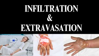 INFILTRATION VERSUS EXTRAVASATION Cause Management amp Prevention nursing viral [upl. by Ark]