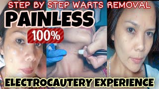 USING ELECTROCAUTERY WARTS REMOVAL STEP BY STEP PROCEDURE human papilloma virus [upl. by Terrijo]