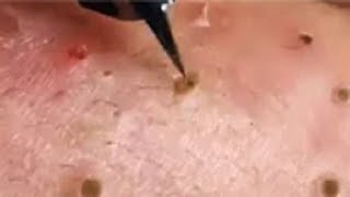 Full Giant Blackheads Popping Video Blackheads Removal 2019 [upl. by Edijabab52]