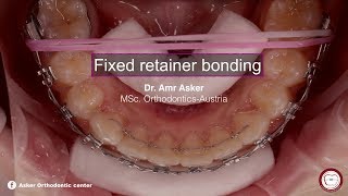 fixed permanent retainer bonding in orthodontics by dr Amr asker [upl. by Farlie]