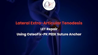 Lateral ExtraArticular Tenodesis LET Repair  OsteoFixPK PEEK Suture Anchor  Knee Arthroscopy [upl. by Azal]