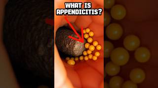 What Is Appendicitis Hidden Danger in Your Abdomen [upl. by Amathist]