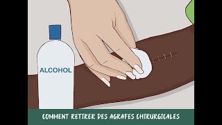 Comment retirer des agrafes chirurgicales [upl. by Ettedanreb]