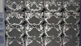 Filming of HRCT Temporal Bone on GE 16 Slice Scanner [upl. by Godden928]