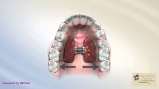 Posterior Crossbite with Functional Shift [upl. by Knut]