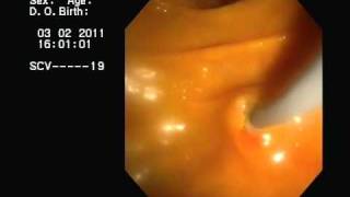 CPRE y drenaje de Colangitis Aguda ERCP acute cholangitis [upl. by Janicki]