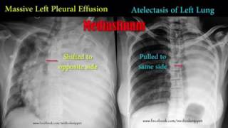 Ventricular Bigeminy [upl. by Wentworth]