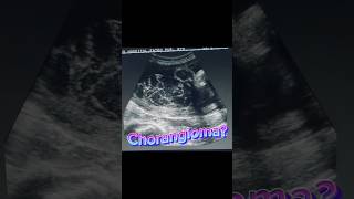 Placenta Mass  Chorangioma  Normal Fetal Scan  Anomaly Ultrasound [upl. by Garv598]