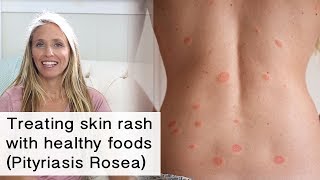 Treating skin rash and inflammation with healthy foods Pityriasis Rosea [upl. by Iruam]