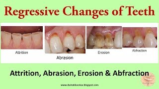 Regressive Changes of Tooth  Attrition Abrasion Abfraction and Erosion [upl. by Yawnoc]