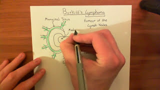 Burkitts Lymphoma Part 1 [upl. by Agustin243]