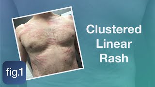 What caused this cluster of linear rashes [upl. by Llireva]