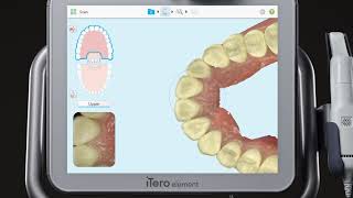 iTero® Scanner Tutorial Using the Delete Tool [upl. by Kaitlynn]