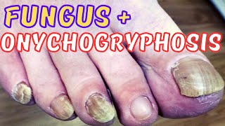 Thick fungal toenails treatment  Rams Horn onychogryphosis [upl. by Romilly]