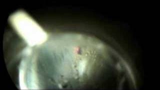 Laser Peripheral Iriditotomy to Prevent Glaucoma Part 2 [upl. by Astrea]