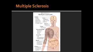 Spinal Cord Lesions  Poliomyelitis WerdnigHoffman Disease amp Multiple Sclerosis [upl. by Attezi342]